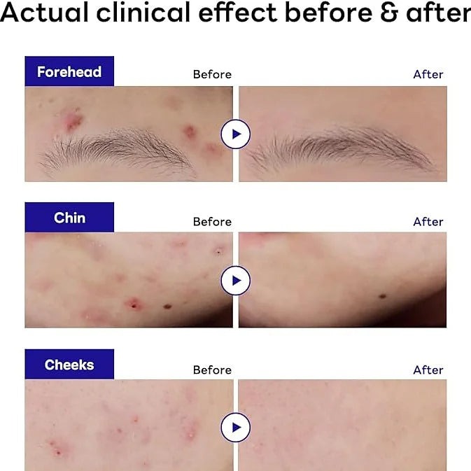 MEDIHEAL Derma Clear Trouble Spot Patch – 44 Patches